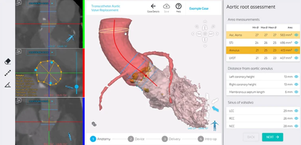 Materialise mimics planner 中 tavr 手术的解剖学概述。 图片来自 materialise。