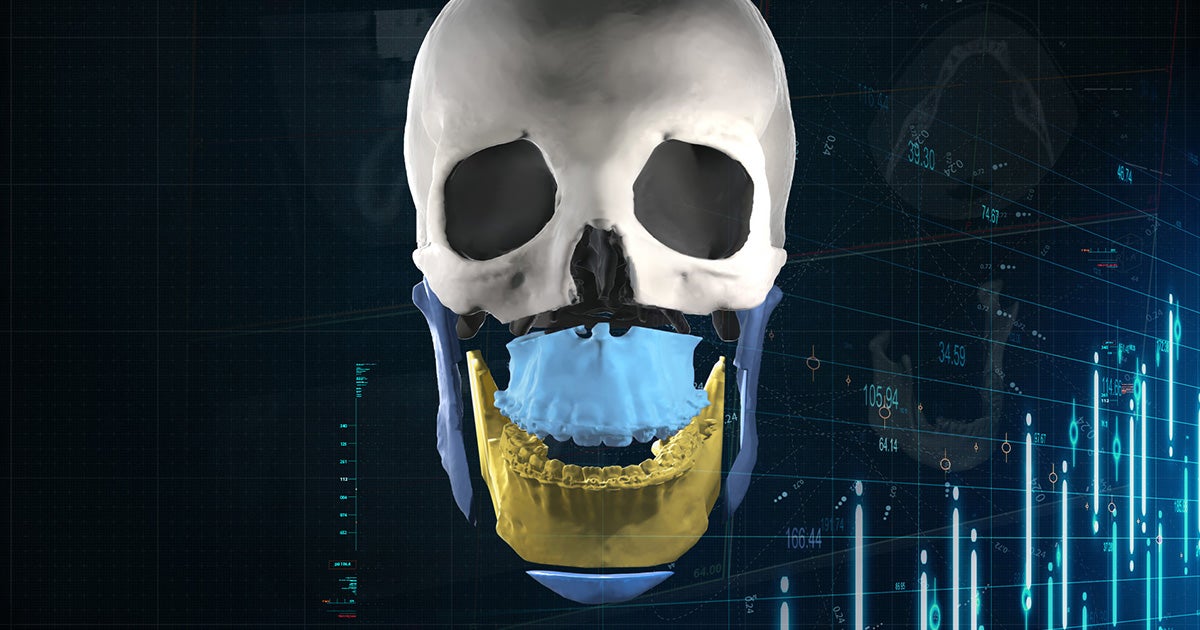 Og mimics enlight cmf orthognathic skull 3d 打印财务状况：materialise 的多元化产品组合推动第三季度增长 - 3d打印行业资讯网